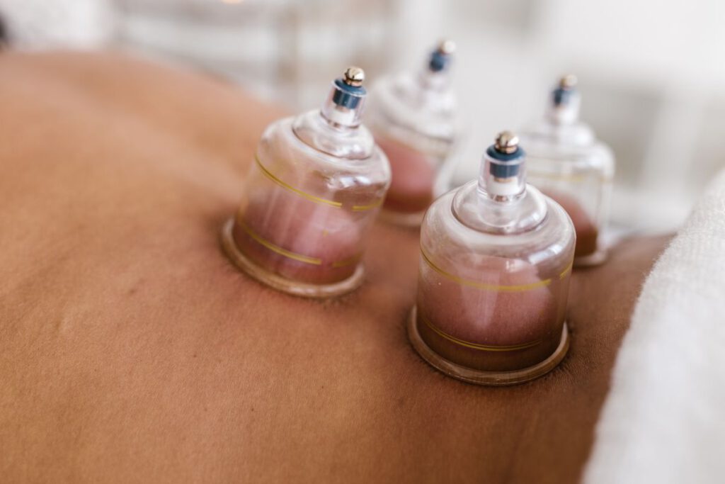 Cuppingcups op de rug tijdens een cuppingbehandeling