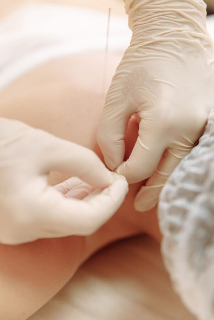 Fysiotherapeut voert dry needling uit met een dunne naald